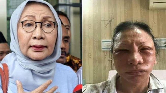 Ratna Sarumpaet Membantah Bukan dianiaya Tapi Sedot Lemak Pipi