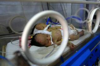 Khaleq dan Rahim, Bayi Berkepala Dua di Yaman yang Menanti Diselamatkan